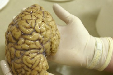 ثلاثة آلاف دماغ بشري تحت البحث لدراسة الأمراض النفسية
