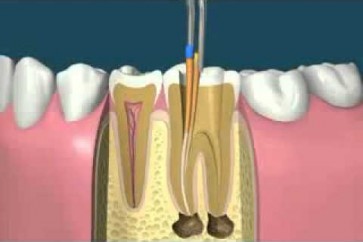 ثمة إمكانية لتقوية الأسنان على نحو يجعلها تعالج نفسها ذاتيا